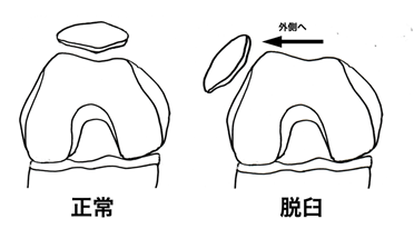 図1: 膝蓋骨脱臼のイメージ