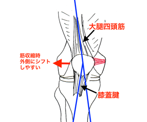 図3: 筋収縮時、膝蓋骨は外側にシフトしやすい
