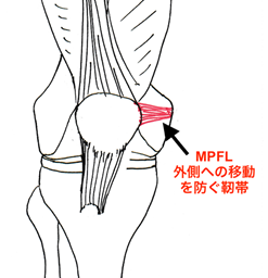 図4: 内側膝蓋大体靭帯（MPFL）の模式図