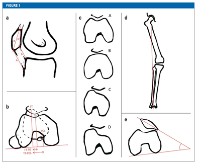 図5: 膝蓋骨脱臼の解剖学的リスク因子