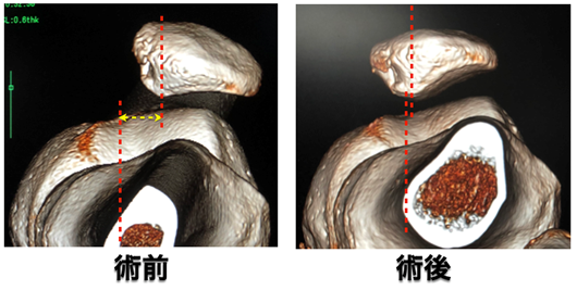 図7: 術前、術後の膝蓋骨位置